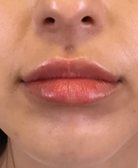 Dermal Fillers Case 46 After Image