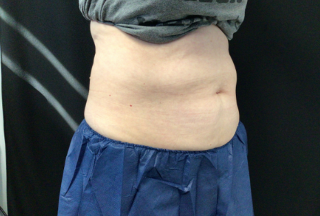 Coolsculpting® ELITE Case 45 After Image