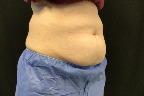 Coolsculpting® ELITE Case 45 Before Image