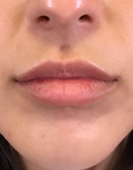 Lip Injections Case 35 Before Image