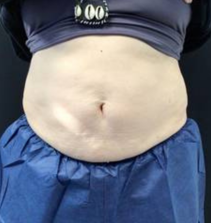Coolsculpting® ELITE Case 54 Before Image