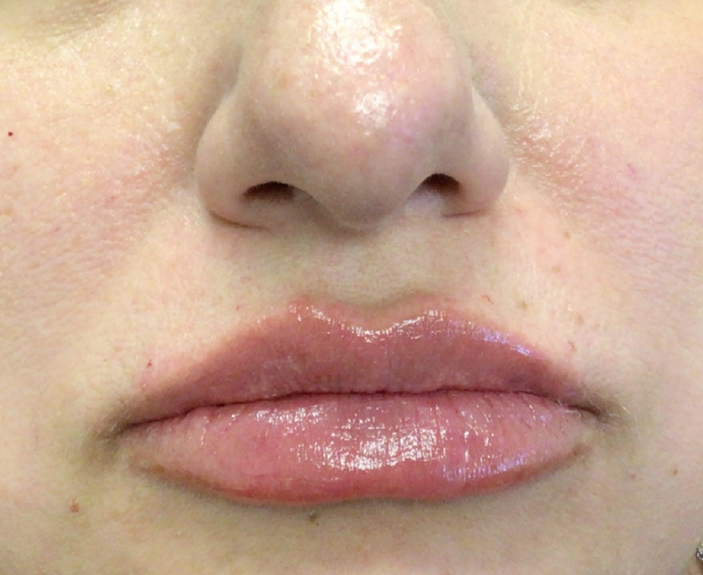 Lip Injections Case 51 After Image