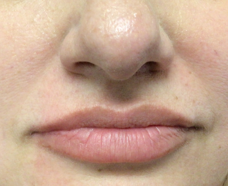 Lip Injections Case 51 Before Image