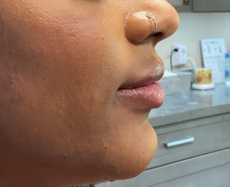 Dermal Fillers Case 66 After Image