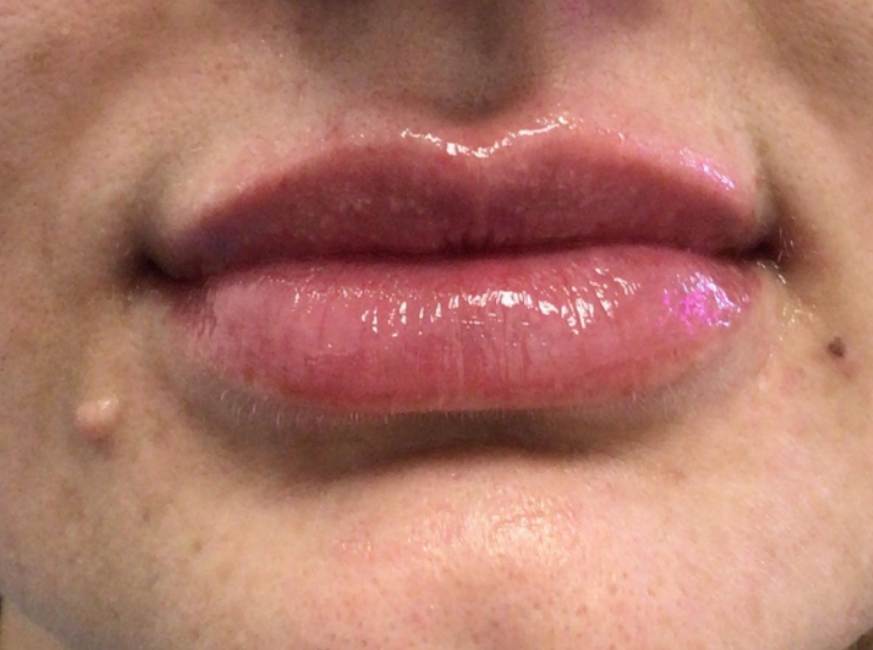 Lip Injections Case 52 After Image