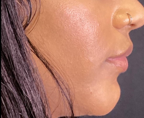 Dermal Fillers Case 66 Before Image