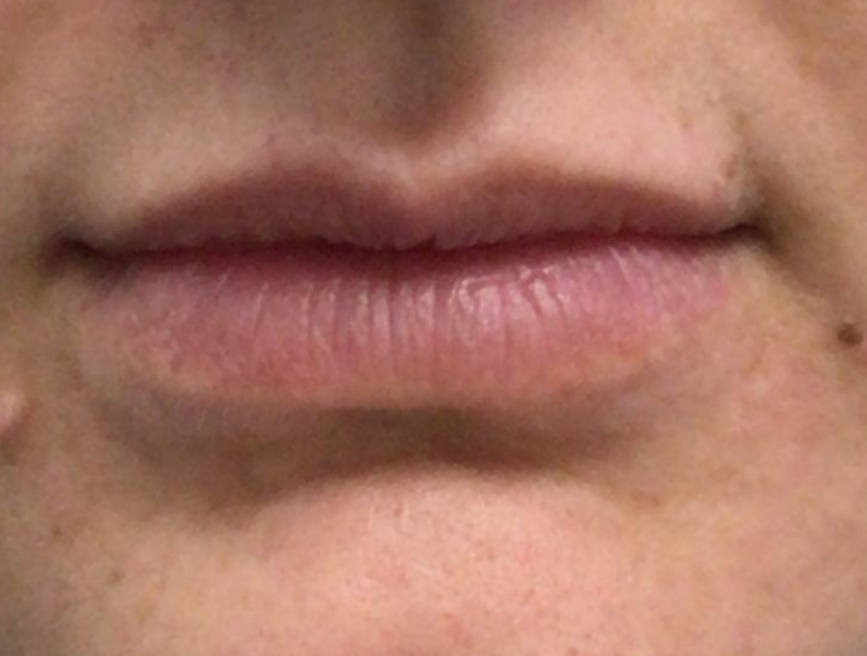Lip Injections Case 52 Before Image