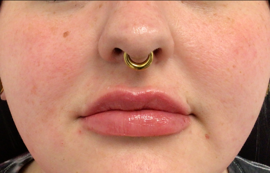 Lip Injections Case 53 After Image
