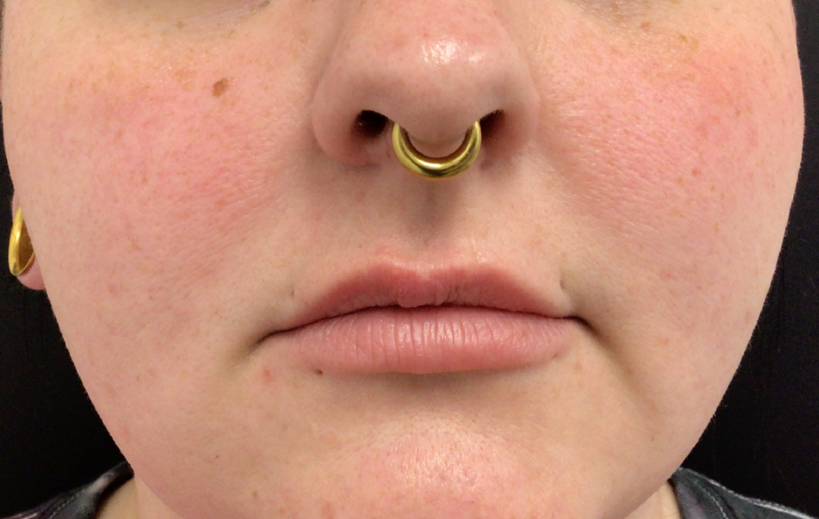 Lip Injections Case 53 Before Image