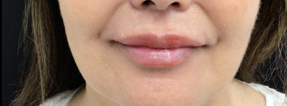 Lip Injections Case 54 After Image