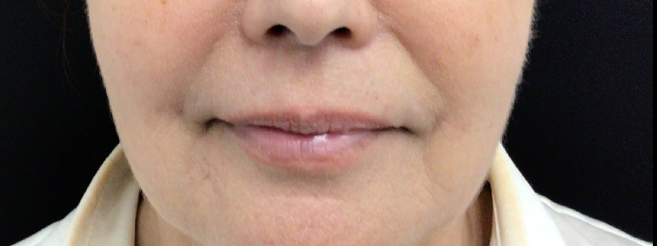 Lip Injections Case 54 Before Image