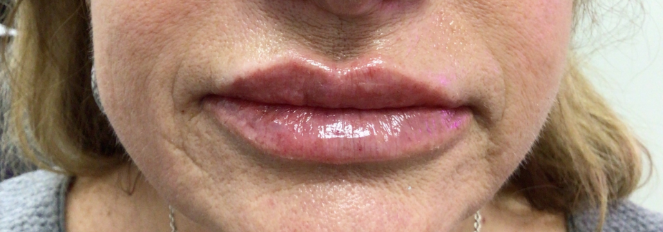 Lip Injections Case 55 After Image