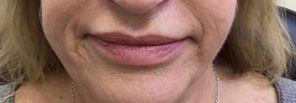 Lip Injections Case 55 Before Image