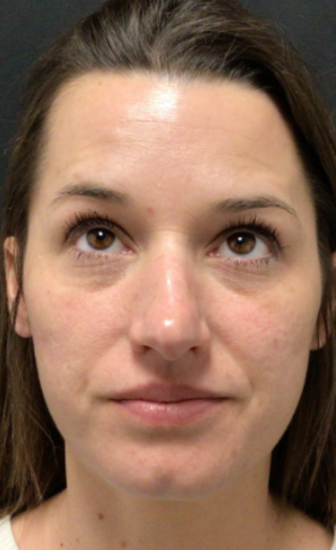 Botox® / Dysport® Case 47 After Image