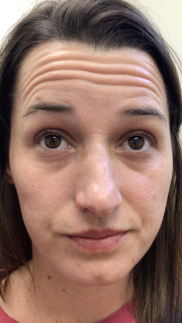 Botox® / Dysport® Case 47 Before Image