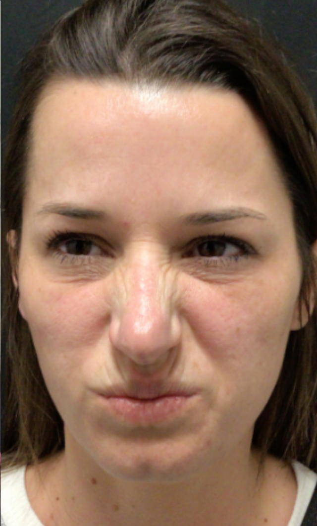 Botox® / Dysport® Case 47 After Image