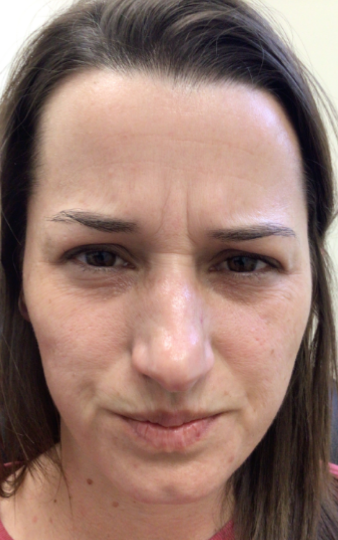 Botox® / Dysport® Case 47 Before Image