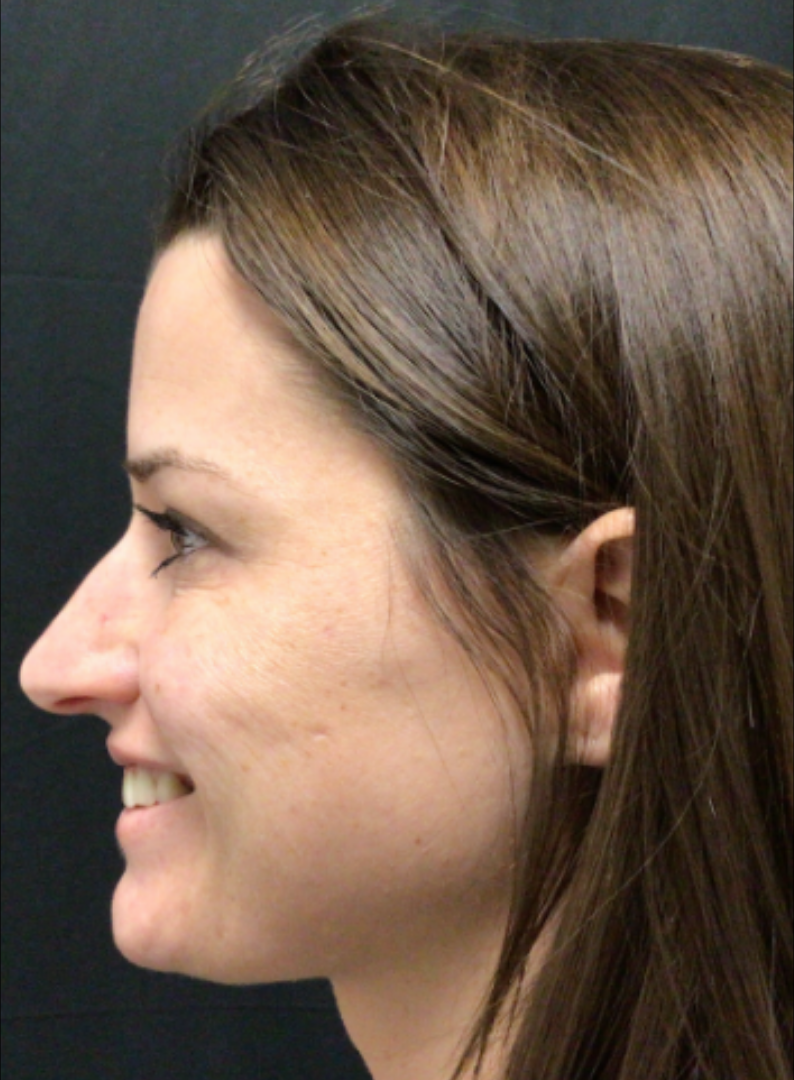 Botox® / Dysport® Case 47 After Image