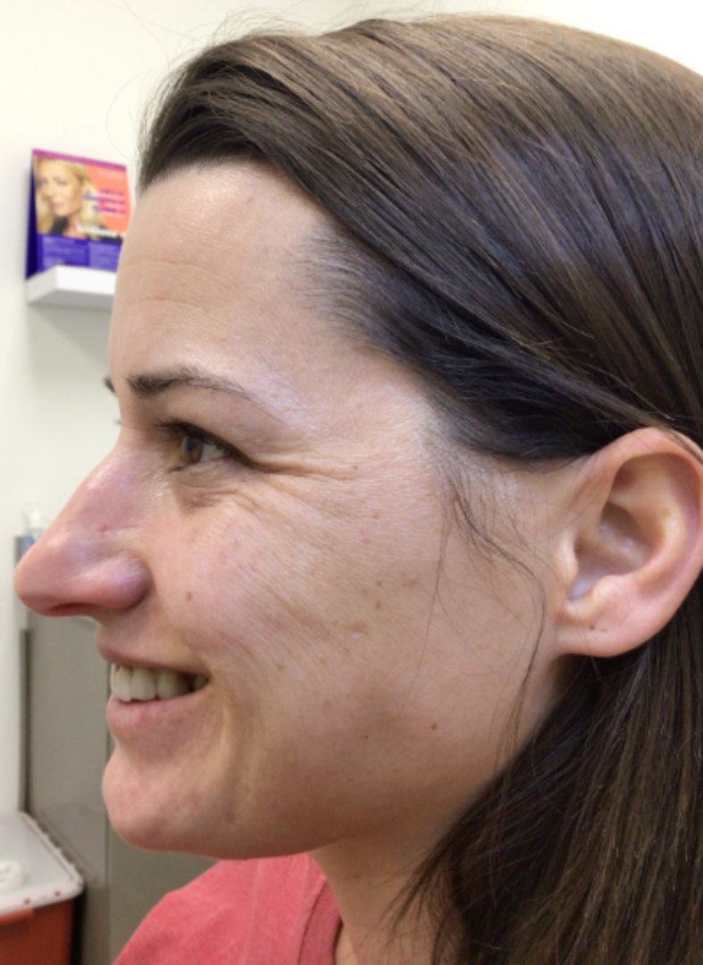 Botox® / Dysport® Case 47 Before Image