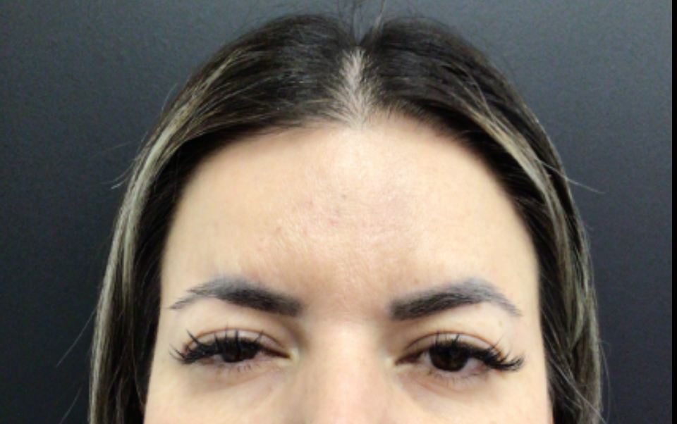 Botox® / Dysport® Case 48 After Image