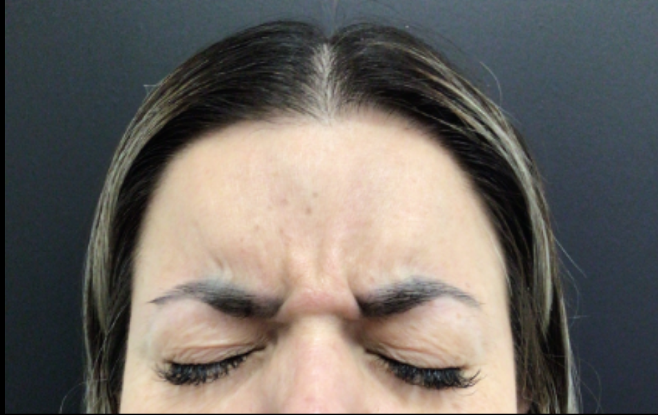 Botox® / Dysport® Case 48 Before Image