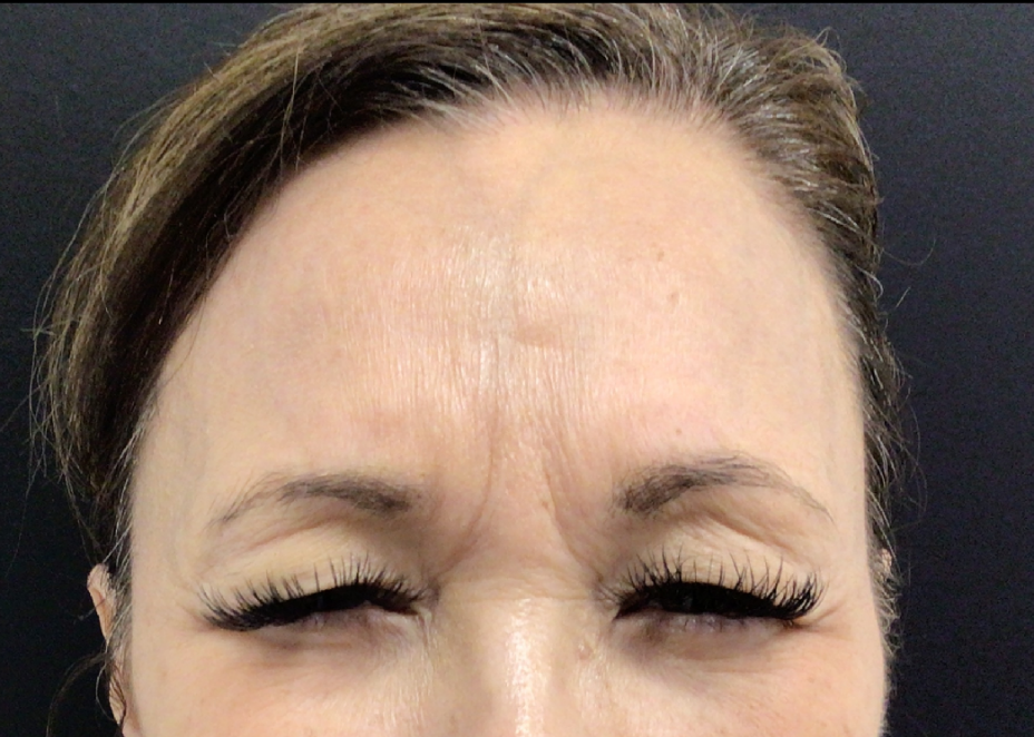 Botox® / Dysport® Case 49 Before Image
