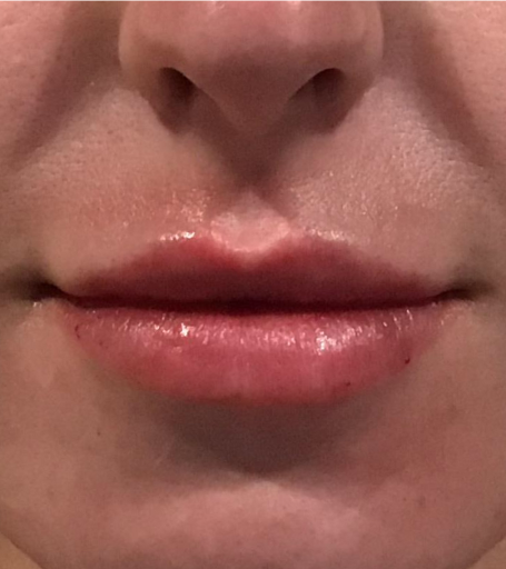 Lip Injections Case 36 After Image