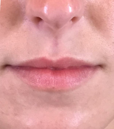 Lip Injections Case 36 Before Image