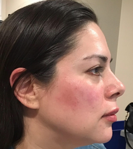 Dermal Fillers Case 64 After Image
