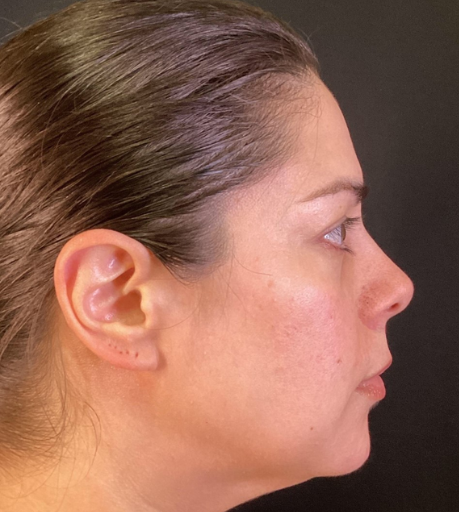 Dermal Fillers Case 64 Before Image