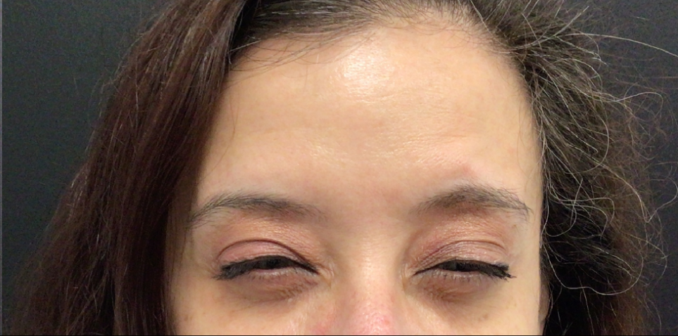 Botox® / Dysport® Case 50 After Image