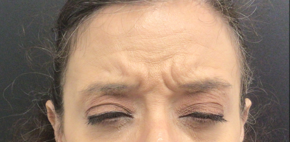 Botox® / Dysport® Case 50 Before Image