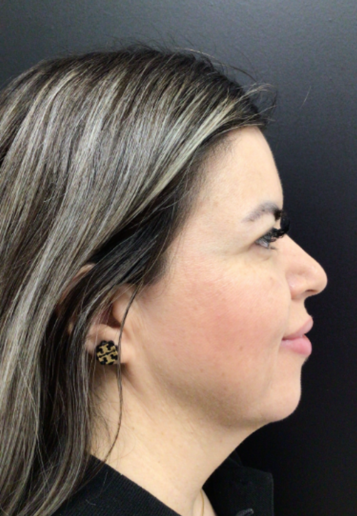 Botox® / Dysport® Case 48 After Image