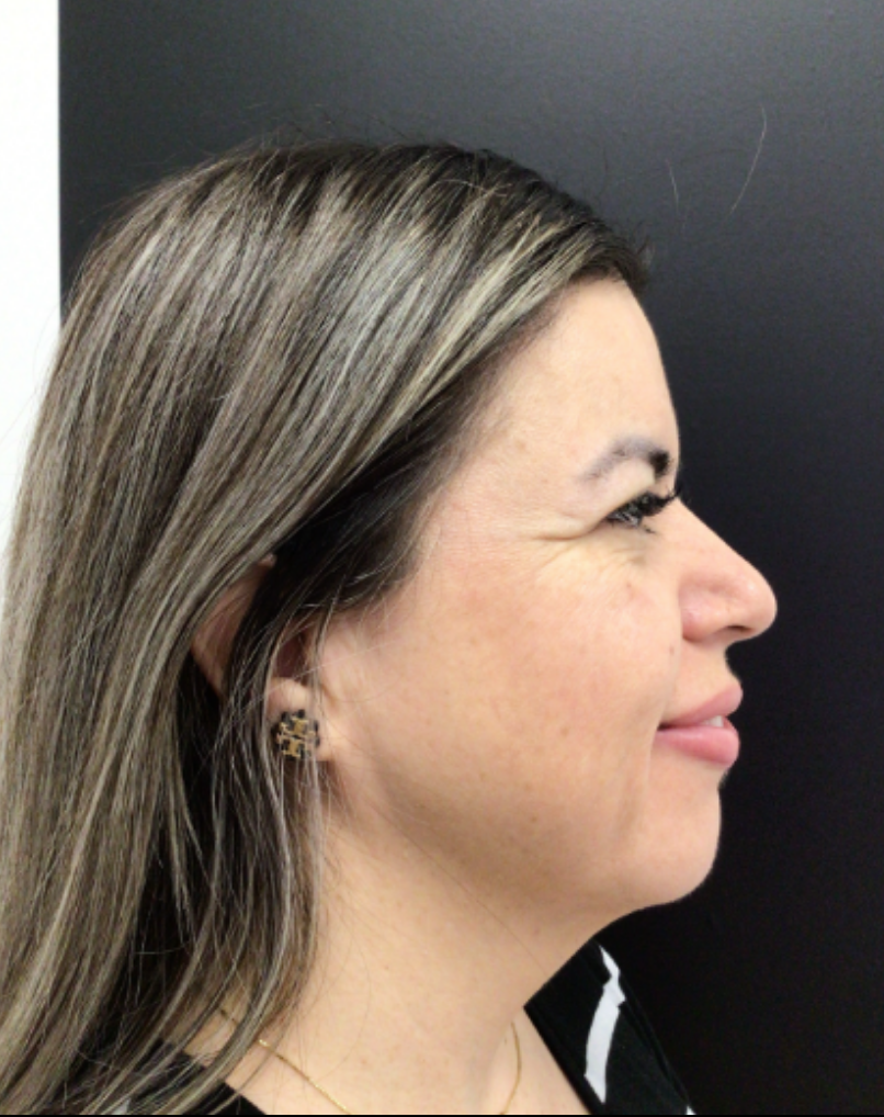 Botox® / Dysport® Case 48 Before Image