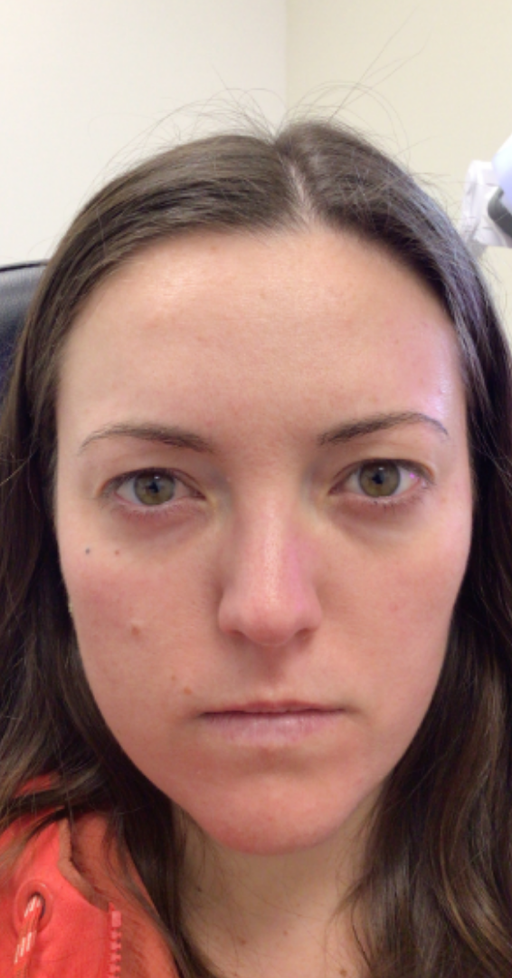 Botox® / Dysport® Case 51 After Image