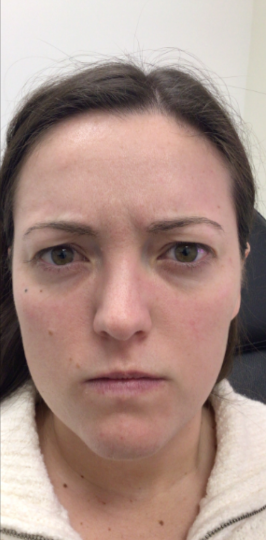 Botox® / Dysport® Case 51 Before Image