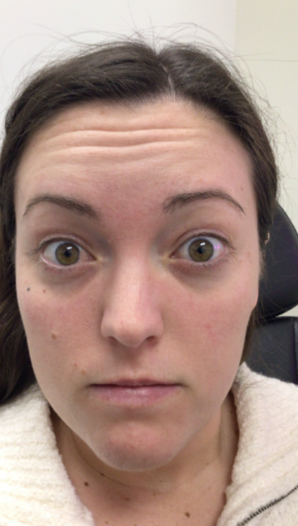 Botox® / Dysport® Case 51 Before Image