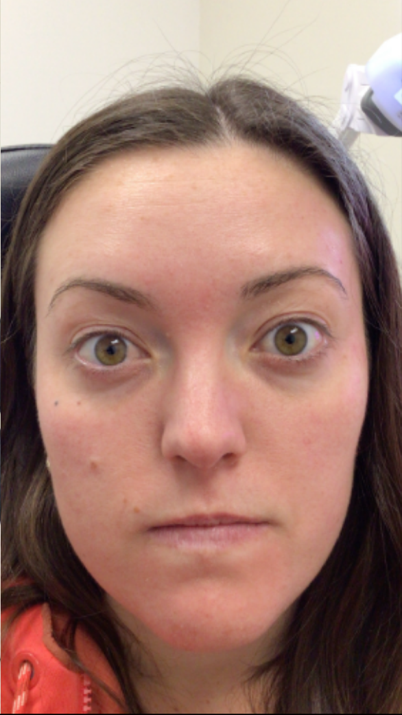 Botox® / Dysport® Case 51 After Image