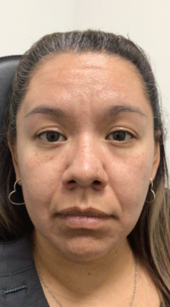 Botox® / Dysport® Case 52 After Image