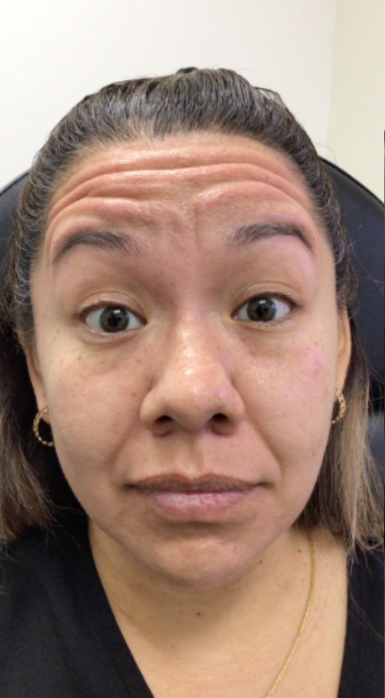 Botox® / Dysport® Case 52 Before Image