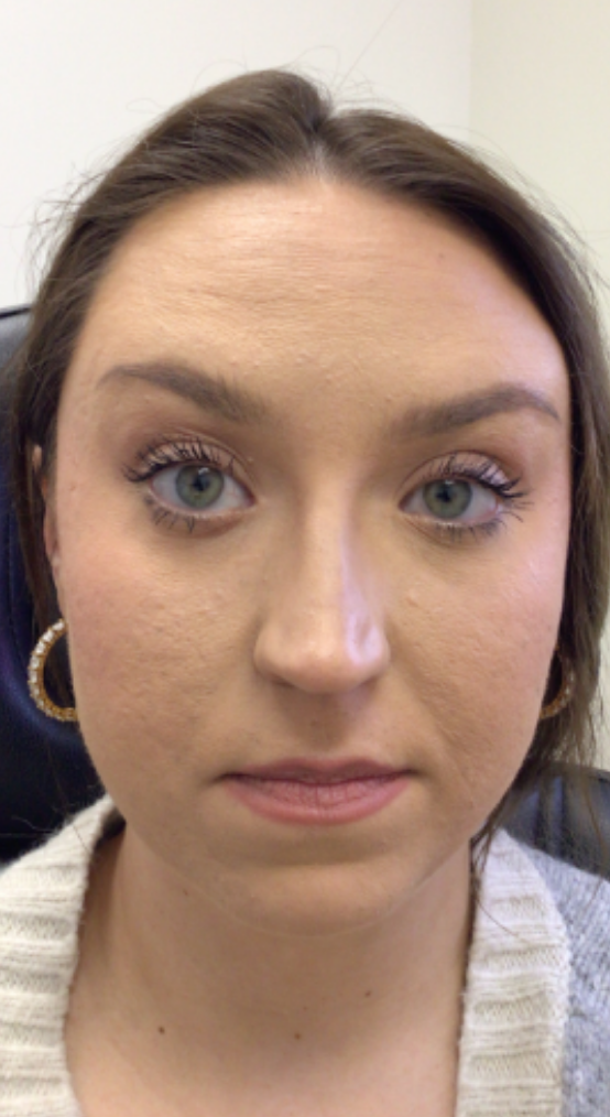 Botox® / Dysport® Case 53 After Image