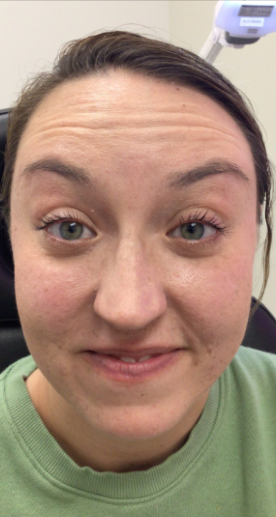 Botox® / Dysport® Case 53 Before Image