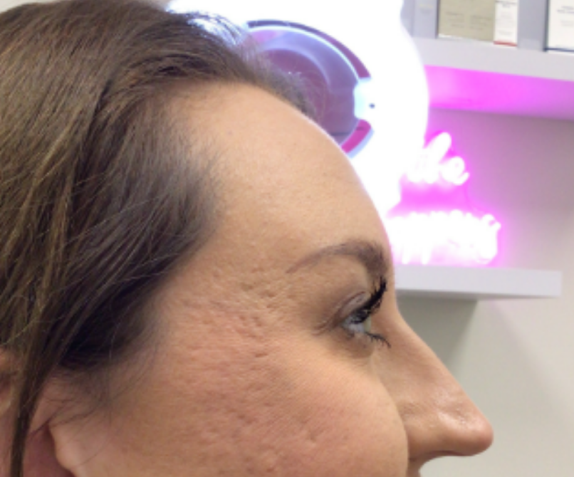Botox® / Dysport® Case 54 After Image