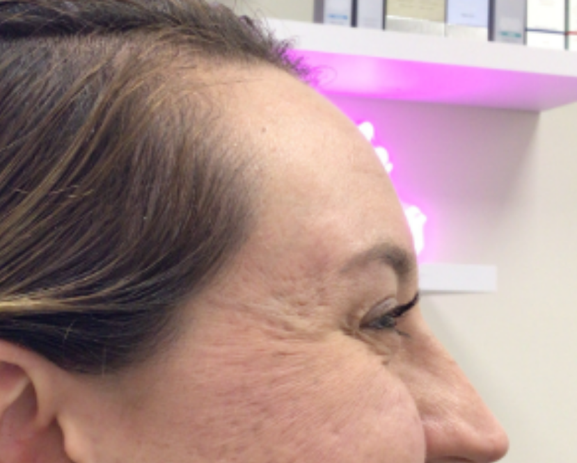 Botox® / Dysport® Case 54 Before Image