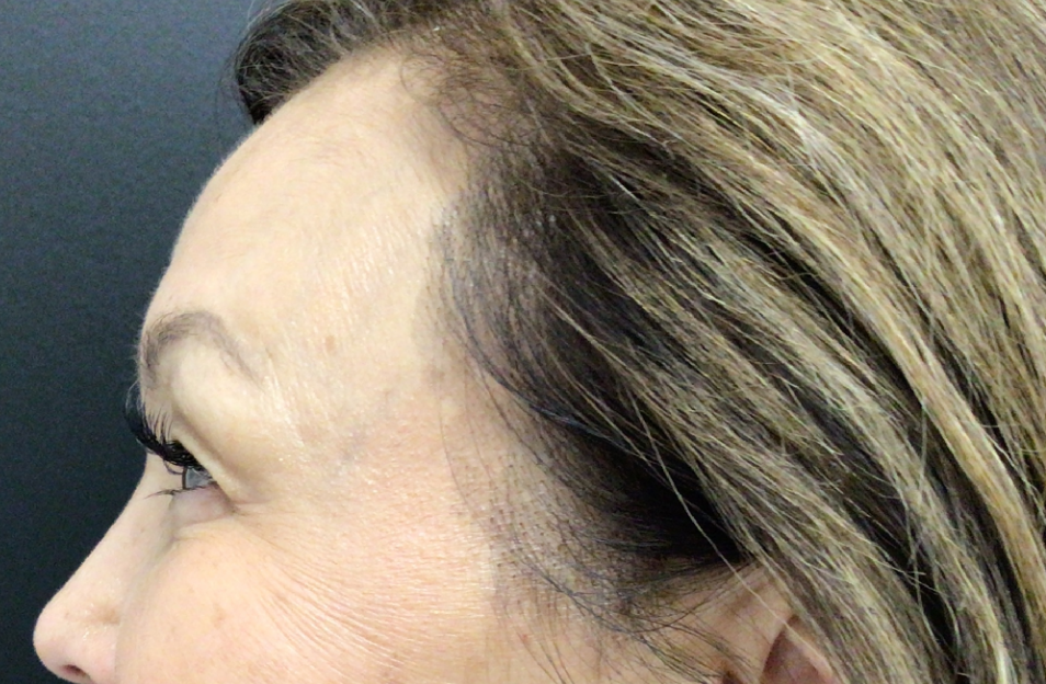 Botox® / Dysport® Case 55 After Image