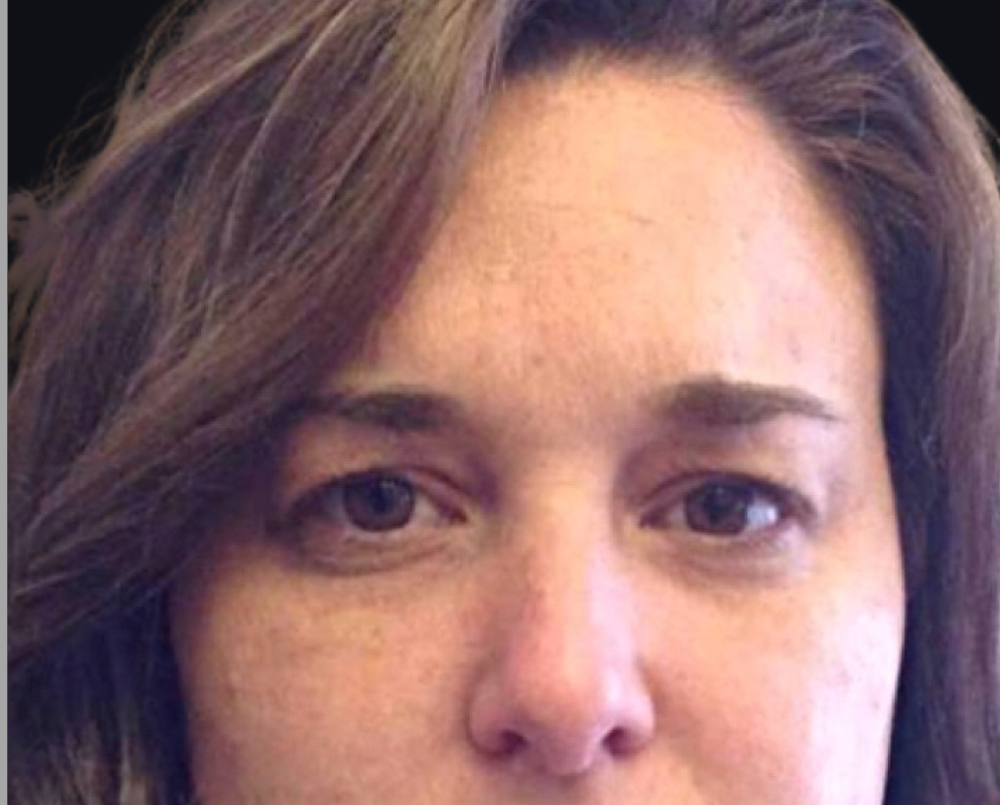 Botox® / Dysport® Case 1 After Image