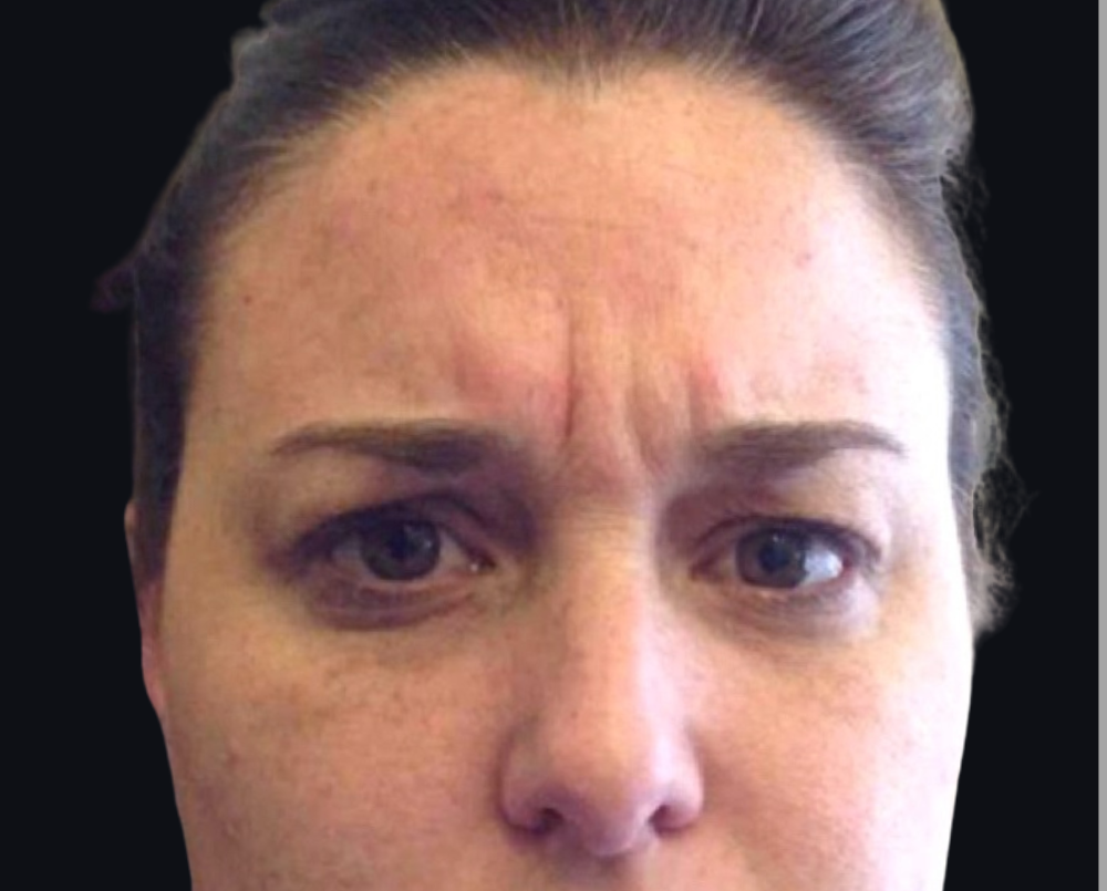 Botox® / Dysport® Case 1 Before Image