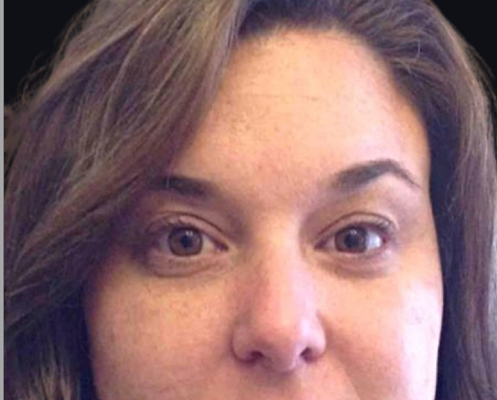 Botox® / Dysport® Case 1 After Image