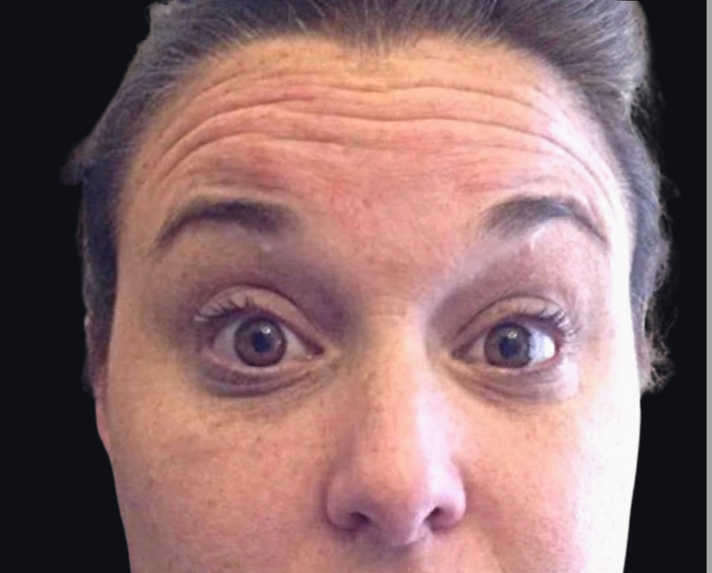 Botox® / Dysport® Case 1 Before Image