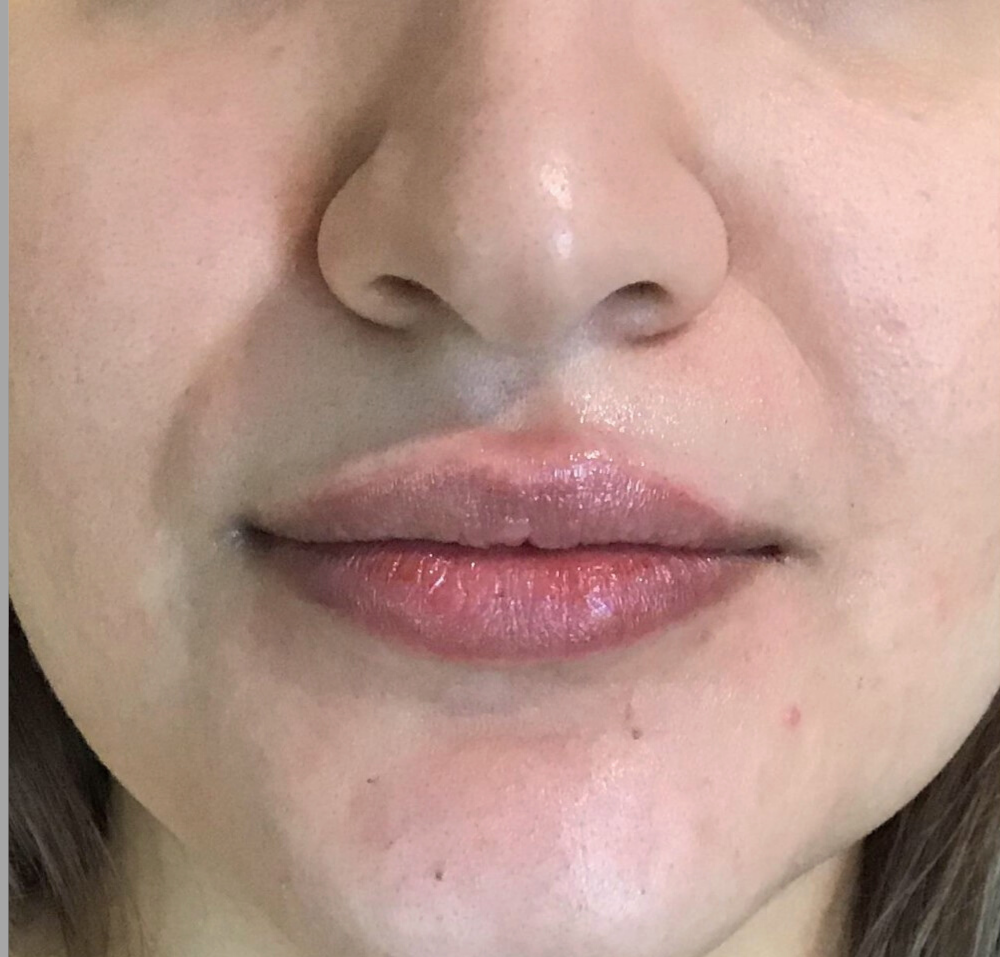 Lip Injections Case 1 After Image